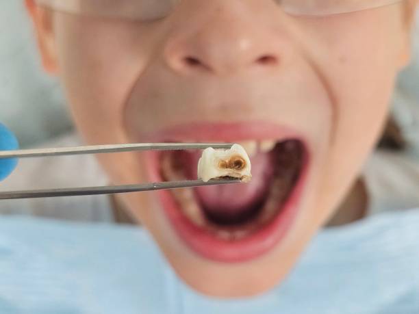 Best Emergency Dentist for Lost Fillings or Crowns in Silverton, OR